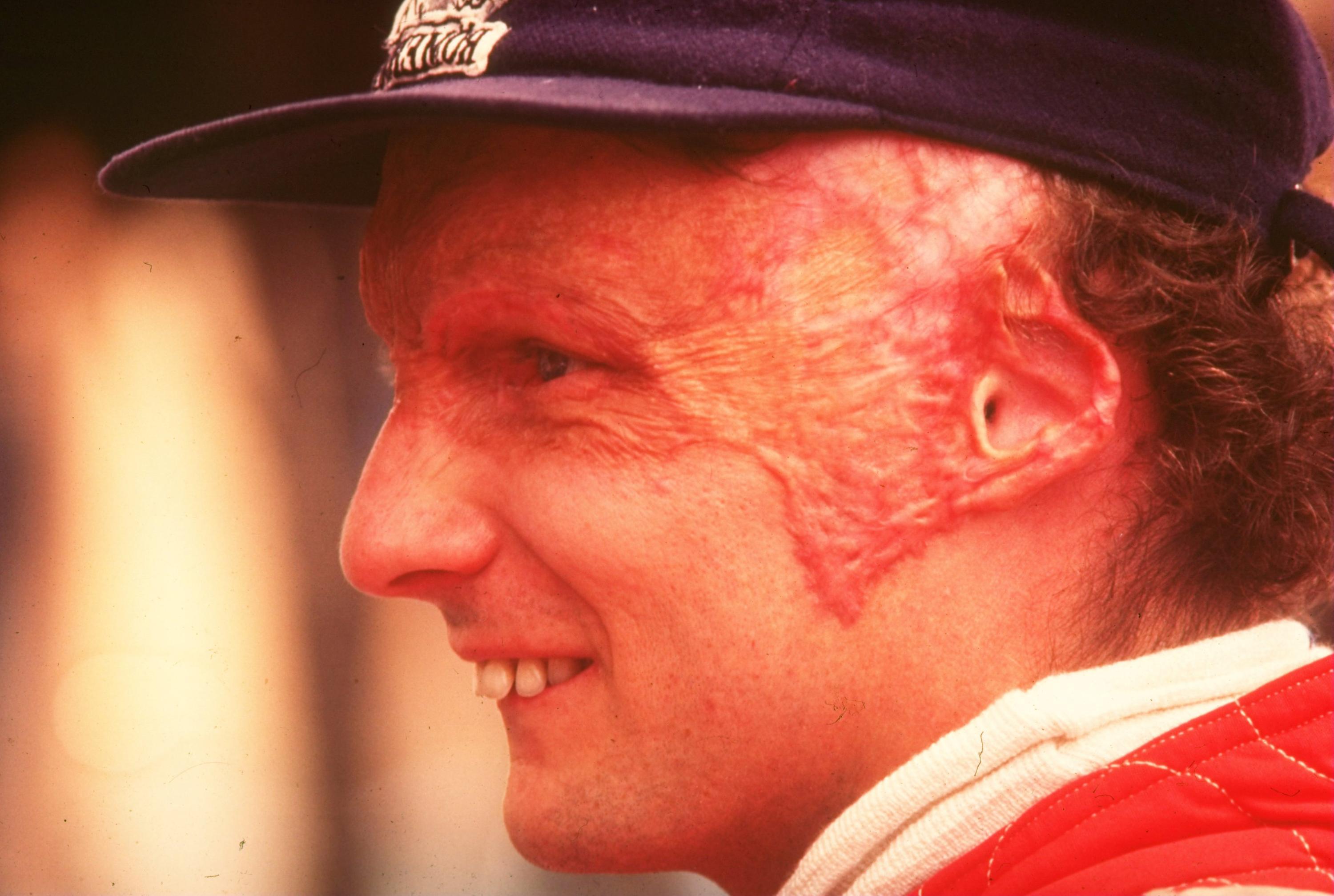 Niki Lauda Unfall Verletzungen