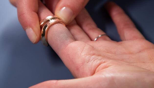 Verfärbungen durch Modeschmuck sind am Finger zu sehen