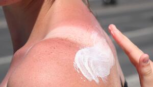 Eine Frau trägt Creme auf einen Sonnenbrand auf
